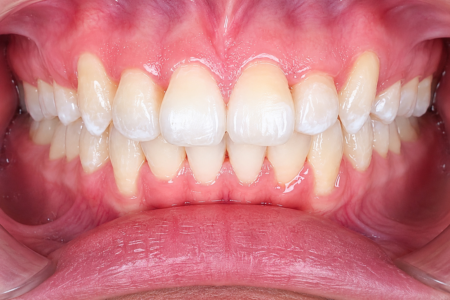 Self-Ligating braces - After